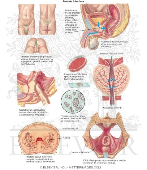 Watermarked preview of labeled image: Diseases of Prostate: Prostate Infections