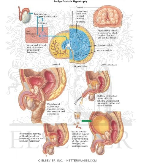 the symptoms and treatment of prostate cancer a malignant disease There are many treatment options for malignant neoplasms of the prostate since it is a slow growing tumor, if it is found in the elderly, the doctor may opt to just observe the patient and monitor psa levels instead of doing any aggressive measures. the symptoms and treatment of prostate cancer a malignant disease There are many treatment options for malignant neoplasms of the prostate since it is a slow growing tumor, if it is found in the elderly, the doctor may opt to just observe the patient and monitor psa levels instead of doing any aggressive measures.