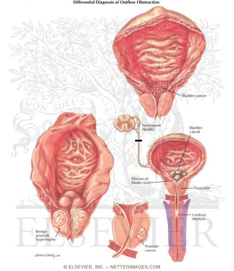 Watermarked preview of labeled image: Diseases of Prostate: Differential Diagnosis of Overflow Obstruction