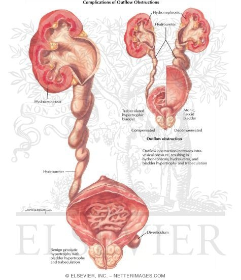 Watermarked preview of labeled image: Diseases of Prostate: Diseases of Overflow Obstruction