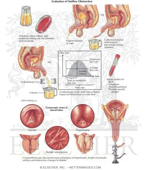 Watermarked preview of labeled image: Diseases of Prostate: Evaluation of Overflow Obstruction