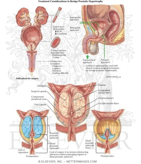 Watermarked preview of labeled image: Diseases of Prostate: Treatment Considerations In Benign Prostatic Hypertrophy (BPH)