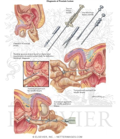 Watermarked preview of labeled image: Diseases of Prostate: Diagnosis of Prostate Lesion