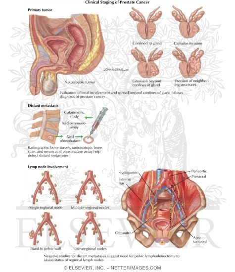 Watermarked preview of labeled image: Diseases of Prostate: Clinical Staging of Prostate Cancer