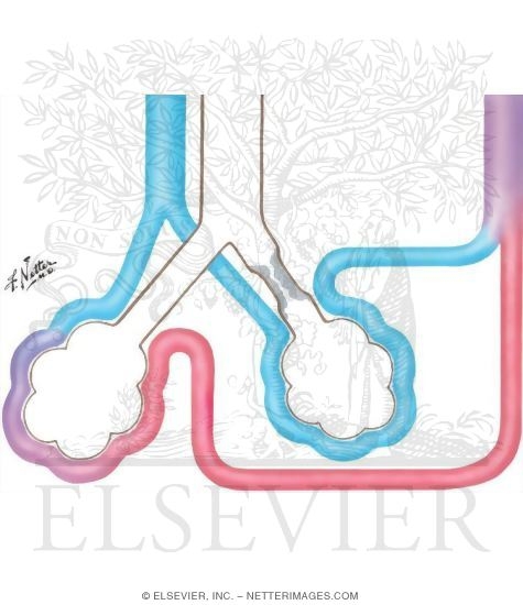 Uneven Ventilation: Uniform Perfusion