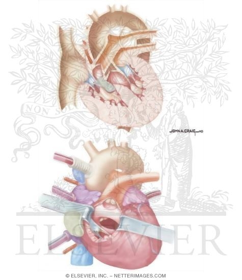 Watermarked preview of unlabeled image: Ventricle Septal Defect