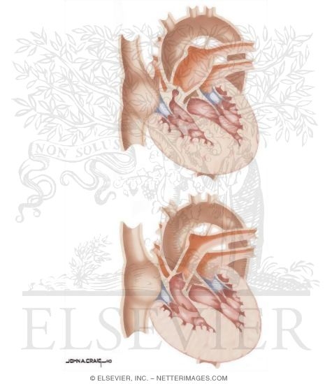 Watermarked preview of unlabeled image: Right Ventricle Outflow Obstruction