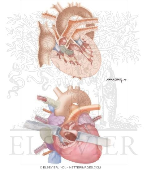 Watermarked preview of unlabeled image: Tetralogy of Fallot