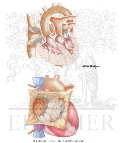 Watermarked preview of unlabeled image: Surgery for Congenital Heart Disease