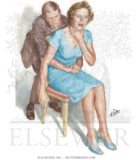 Watermarked preview of unlabeled image: Heimlich Maneuver: Adult Victim, Seated