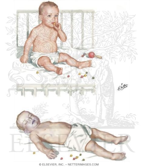 Watermarked preview of unlabeled image: Obstructed Airway: Infant Victim