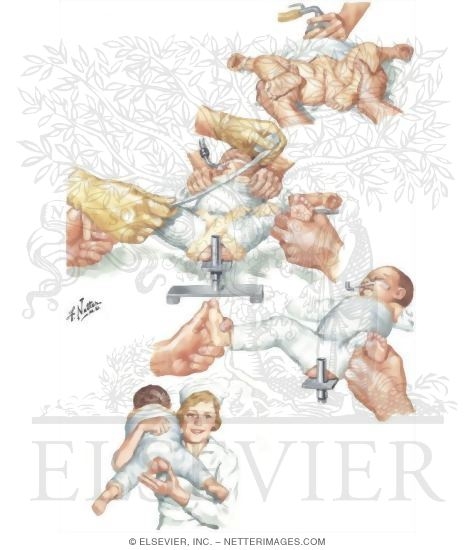 Watermarked preview of unlabeled image: Cast Application