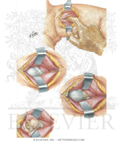 Watermarked preview of unlabeled image: Open Reduction of Congenital Hip Dislocation: Medial Adductor Approach