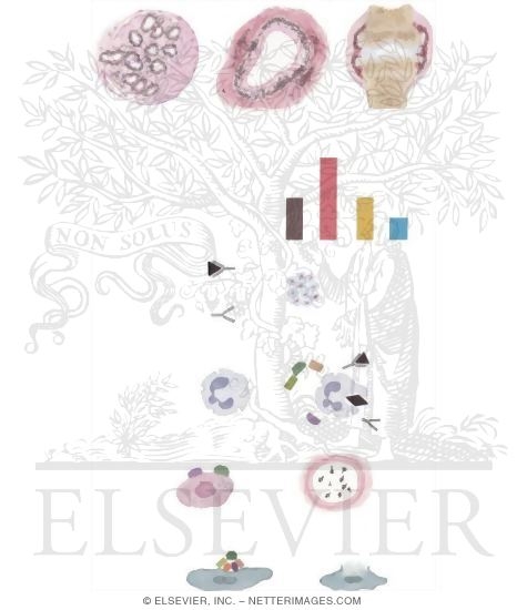 Watermarked preview of unlabeled image: Consequences of Immune Complexes