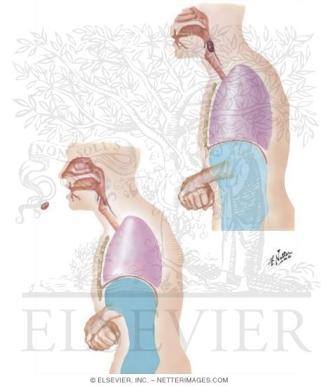 Watermarked preview of unlabeled image: Mechanics of Heimlich Maneuver