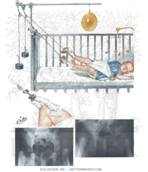 Traction for Dislocated Hip Resistant to Clinical Reduction