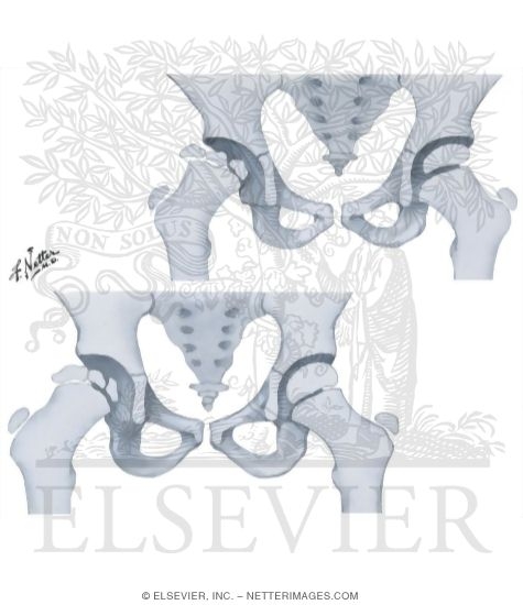 Watermarked preview of unlabeled image: Legg-Calve-Perthes' Disease: Ancillary Prognostic Indicators