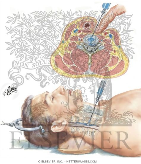 Watermarked preview of unlabeled image: Cervical Epidurography (Discography)