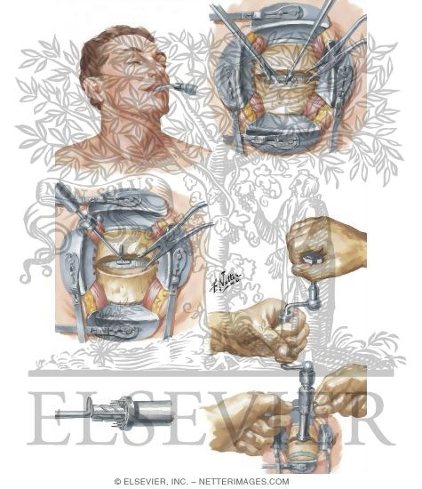 Watermarked preview of unlabeled image: Cervical Intervertebral Disc and Osteophyte Removal With Anterior Interbody Fusion By Dowel Graft
