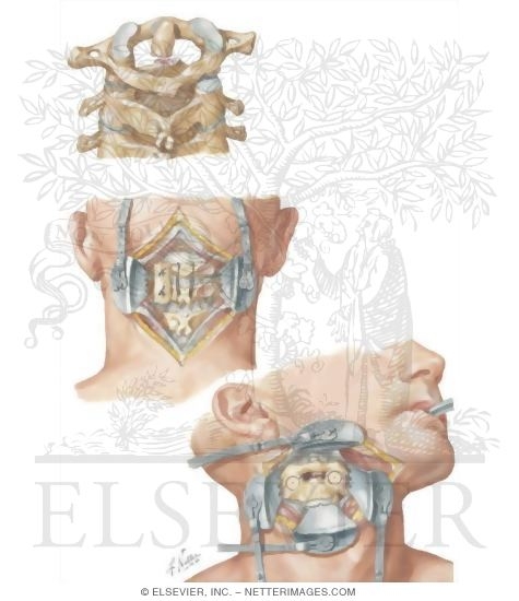 Fracture of Odontoid Process
