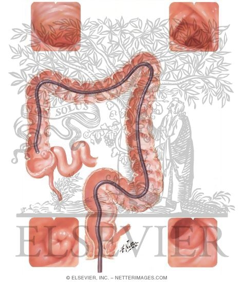 Normal Colonoscopic Findings