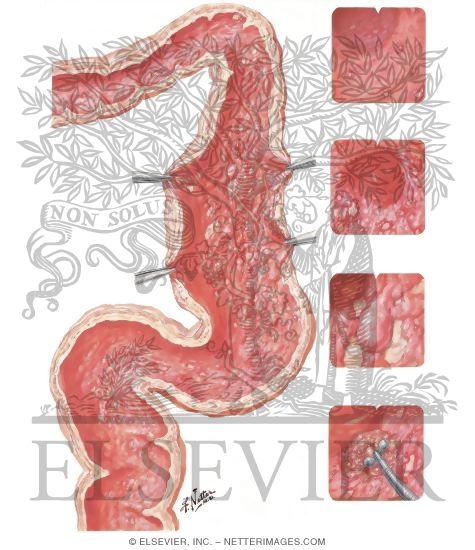 Watermarked preview of unlabeled image: Ulcerative Colitis