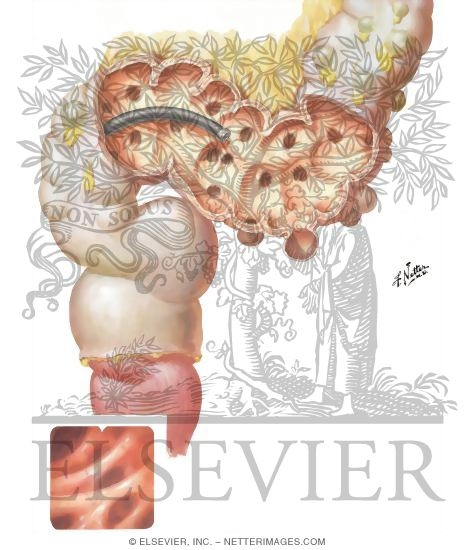 Watermarked preview of unlabeled image: Diverticulosis