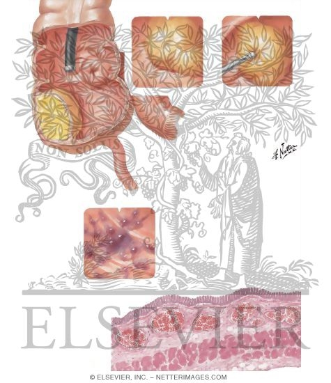 Watermarked preview of unlabeled image: Lipoma: Telangiectasia