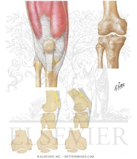 Watermarked preview of unlabeled image: Patellofemoral Stress Syndrome