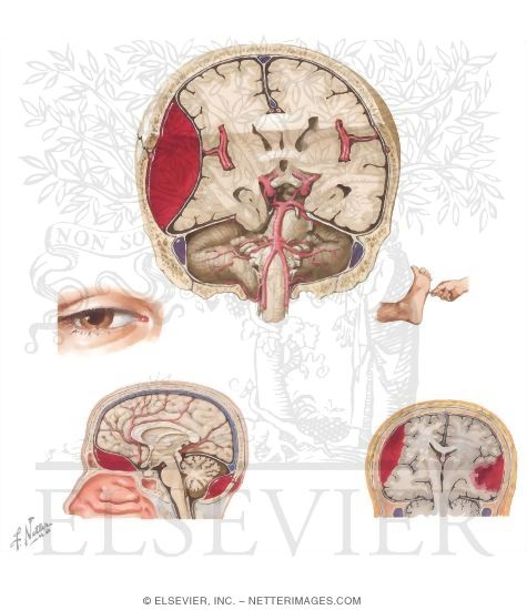 Hematomas