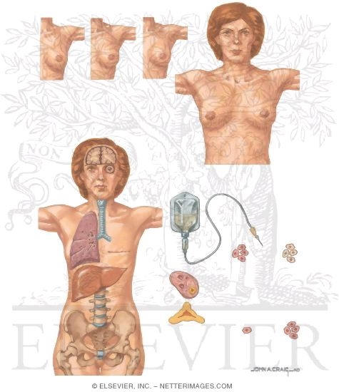 Watermarked preview of unlabeled image: Breast Surgery Cancer: Therapy