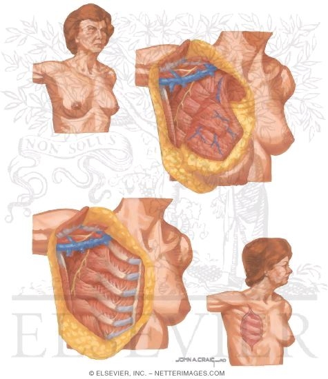 Watermarked preview of unlabeled image: Breast Cancer Surgery: Radical Mastectomy