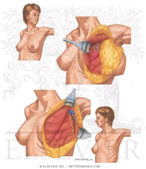 Breast Cancer Surgery: Modified Radical Mastectomy