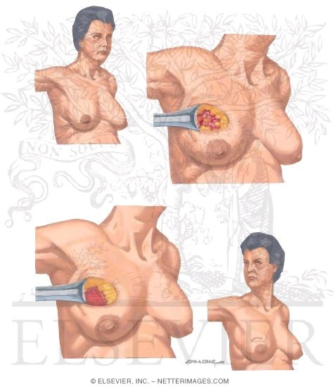 Breast Cancer Surgery: Segmental Mastectomy