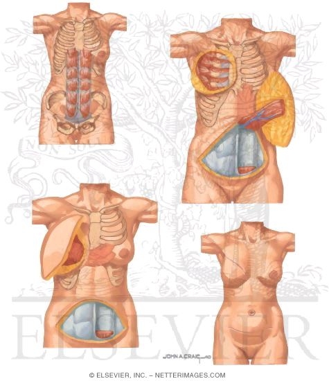Watermarked preview of unlabeled image: Breast Cancer Surgery: Breast Reconstruction With Rectus Abdominus Myocutaneous