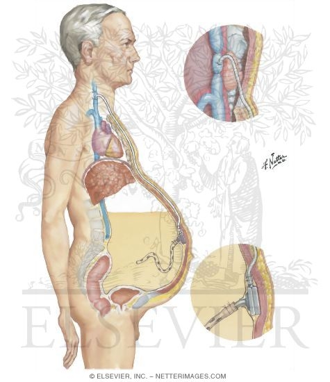 The Leveen Peritoneal-Venous Shunt
