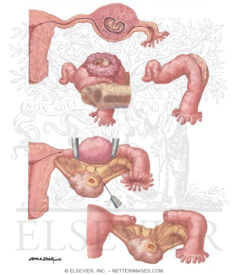 Current Perspectives In Gynecology: Surgical Treatment Of Tubal Pregnancy