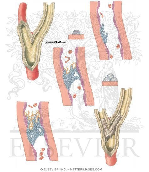 Thrombotic Disorders: Arterial Thrombosis