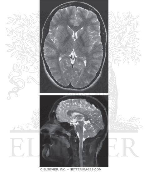 Brain Imaging: Magnetic Resonance Imaging, Axial and Sagittal T2-Weighted Images