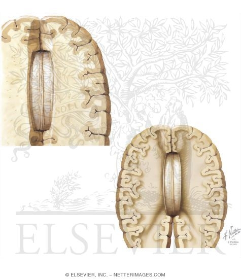 Corpus Callosum