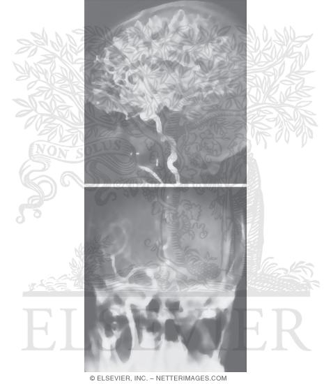 Watermarked preview of unlabeled image: Angiographic Anatomy of the Internal Carotid Artery