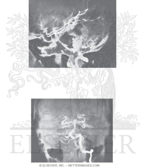 Watermarked preview of unlabeled image: Angiographic Anatomy of the Vertebrobasilar System
