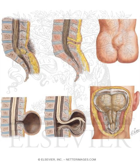neural tube defects