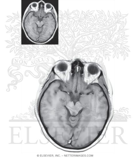 Axial (Horizontal) Sections Through the Forebrain: Level 3 - Midbrain