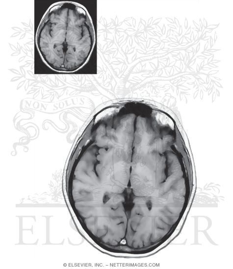 Watermarked preview of unlabeled image: Axial (Horizontal) Sections Through the Forebrain: Level 5 - Anterior Commissure and Caudal Thalamus