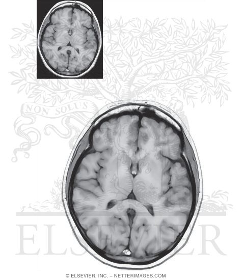 Watermarked preview of unlabeled image: Axial (Horizontal) Sections Through the Forebrain: Level 6 - Caudate and Mid Thalamus