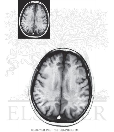 Axial (Horizontal) Sections Through the Forebrain: Level 9 - Body of Corpus Callosum