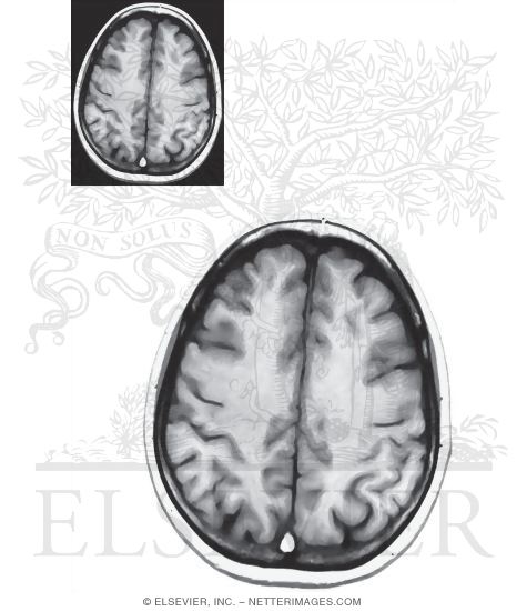 Axial (Horizontal) Sections Through the Forebrain: Level 10 - Centrum Semiovale