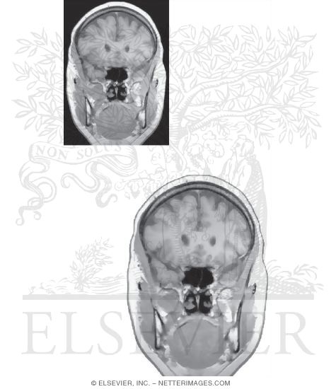 Watermarked preview of unlabeled image: Coronal Sections Through the Forebrain: Level 1 - Genu of Corpus Callosum