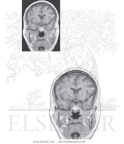 Watermarked preview of unlabeled image: Coronal Sections Through the Forebrain: Level 2 - Head of Caudate Nucleus and Nucleus Accumbens